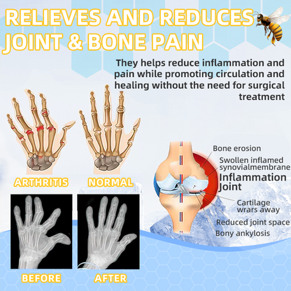 🧊Thonesr™ Bee Venom Freeze Spray (New Zealand Bee Extract - Specialized in the treatment of orthopedic diseases and arthritis pain)