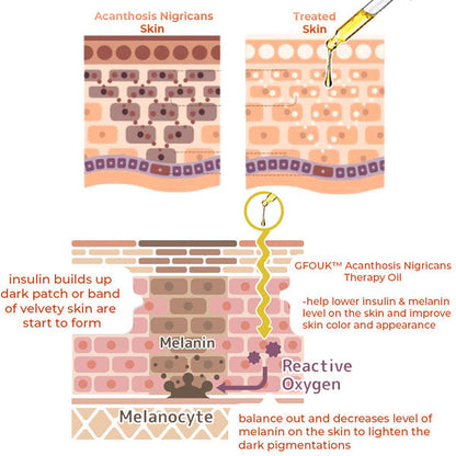 🔥GFOUK™ Acanthosis Nigricans Therapy Oil